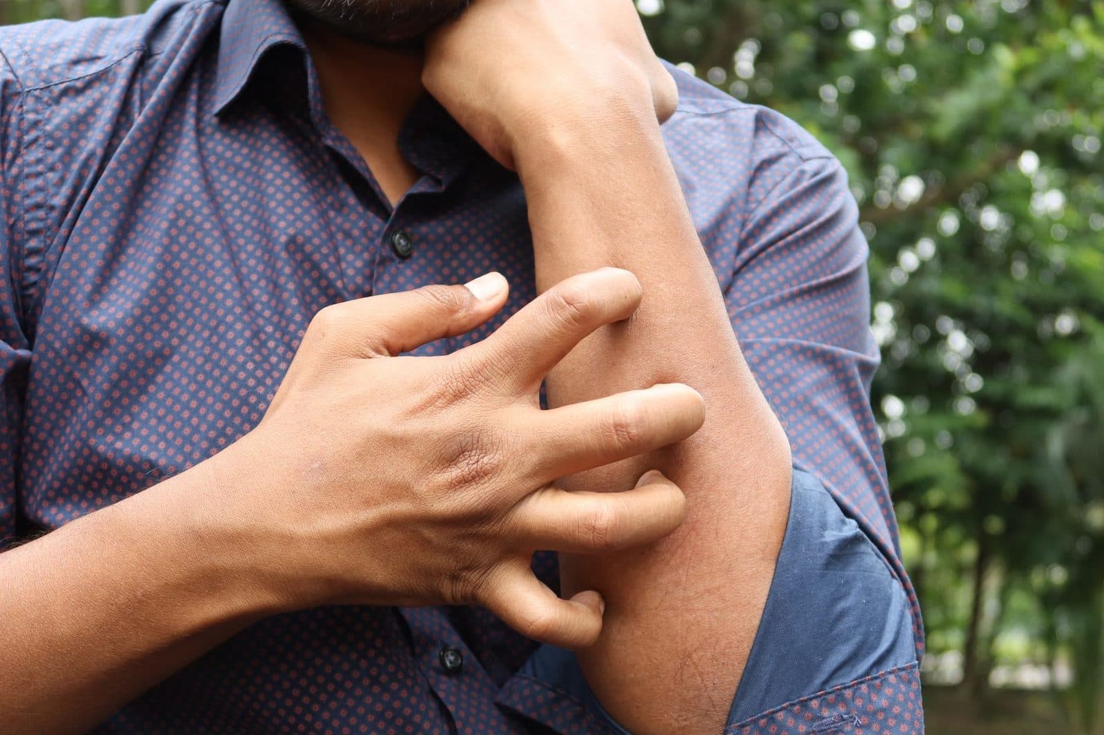 Eczema and Atopic Dermatitis: Beyond Moisturizer