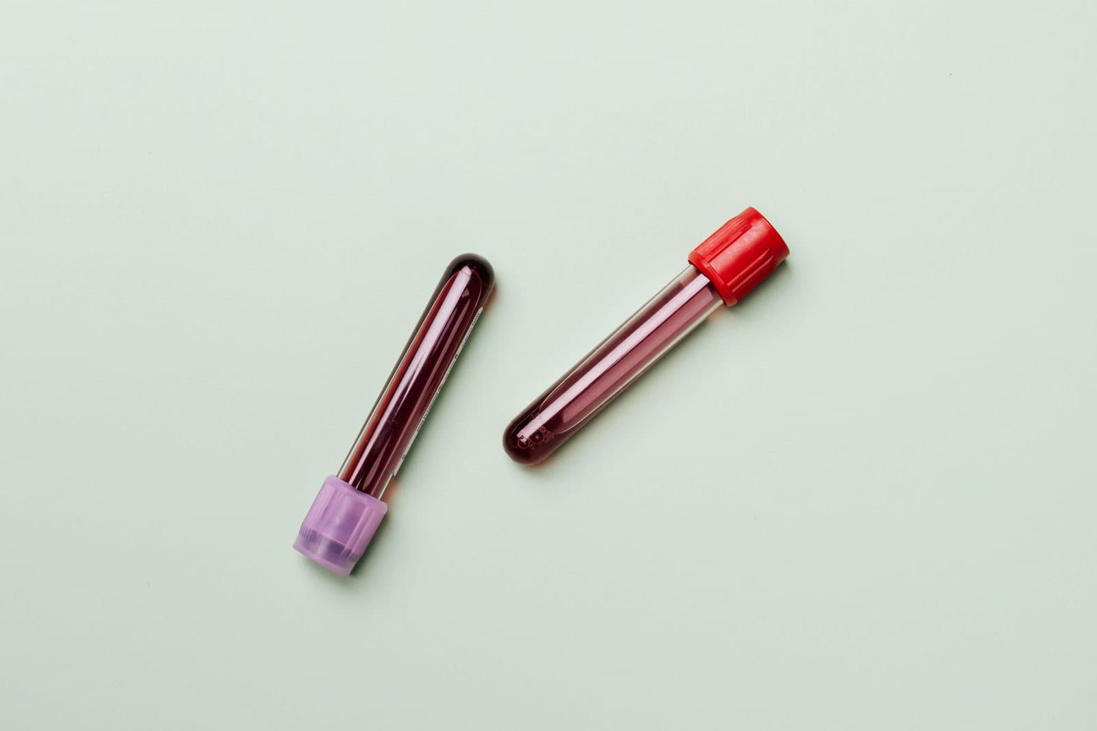 Understanding Your Cholesterol Numbers: LDL, HDL, and Triglycerides